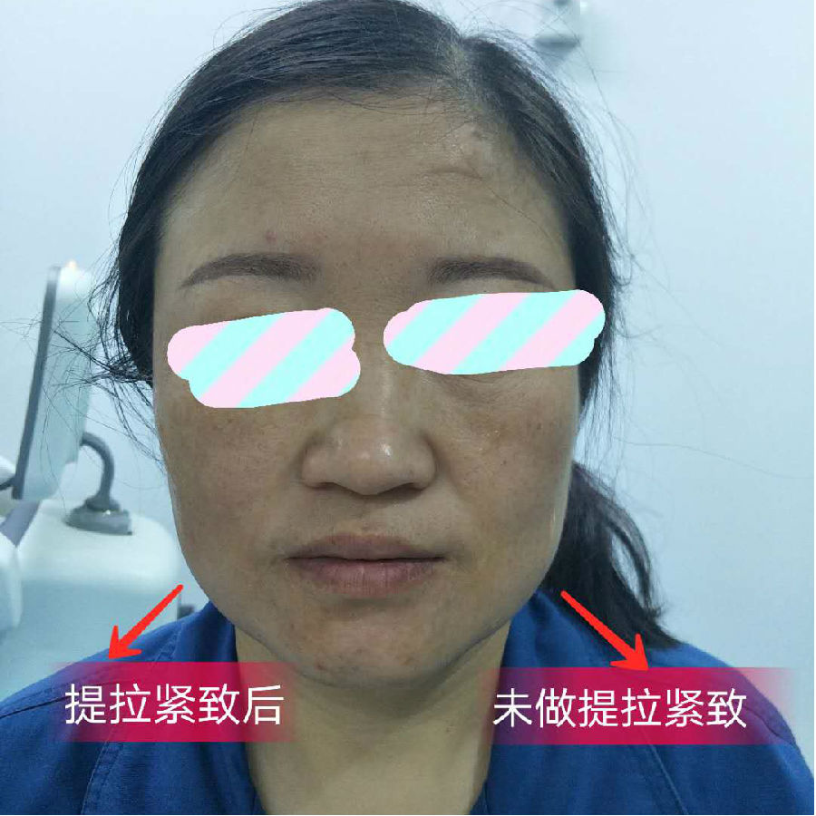 提拉紧致治疗前后对比2_副本.jpg