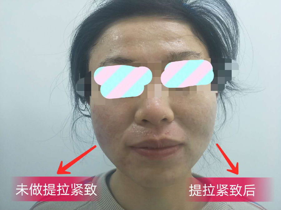 提拉紧致治疗前后对比.png