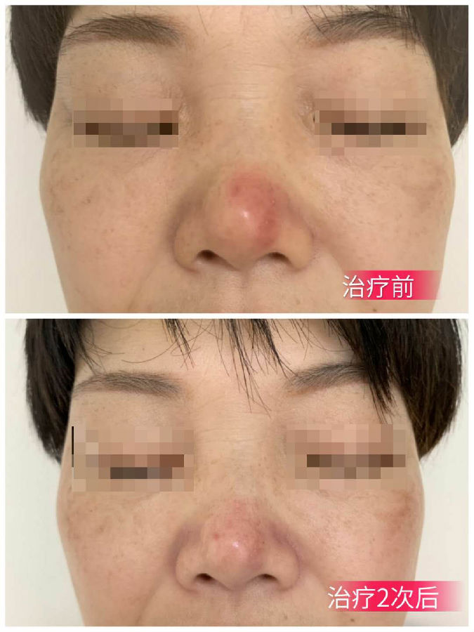 酒渣鼻治疗前后对比.png