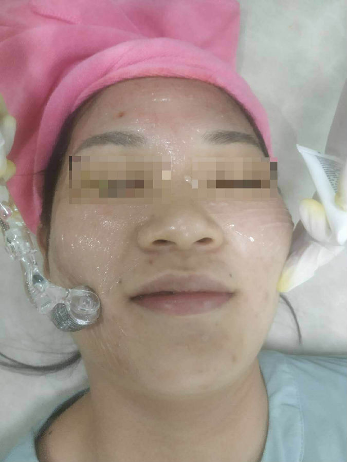 滚针(微针)治疗2.png
