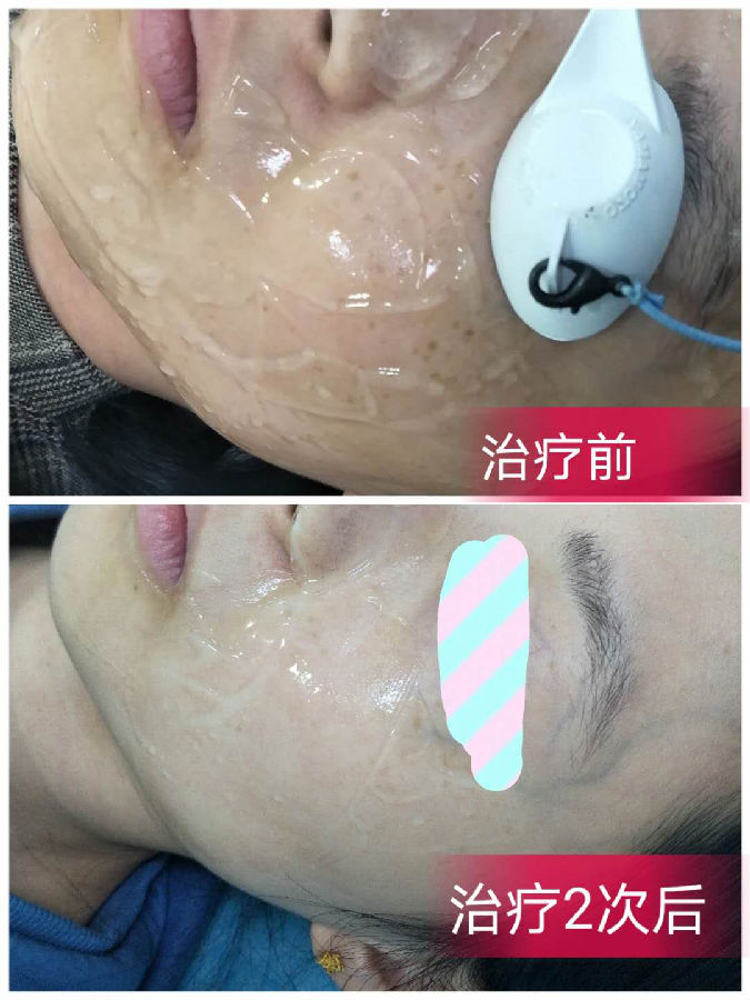 祛斑治疗治疗前后对比.png